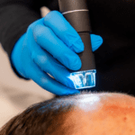 Lamprobe machine used for hair loss treatment at CliniSculpt Aesthetics, Kyalami