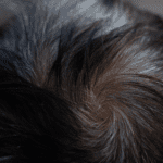 Balding man's crown showing hair loss – hair restoration treatments at CliniSculpt Gauteng